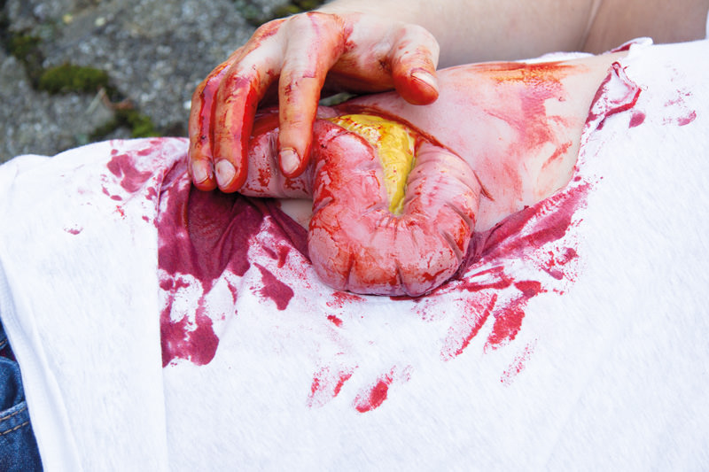 Wundmoulage Dickdarmaustritt