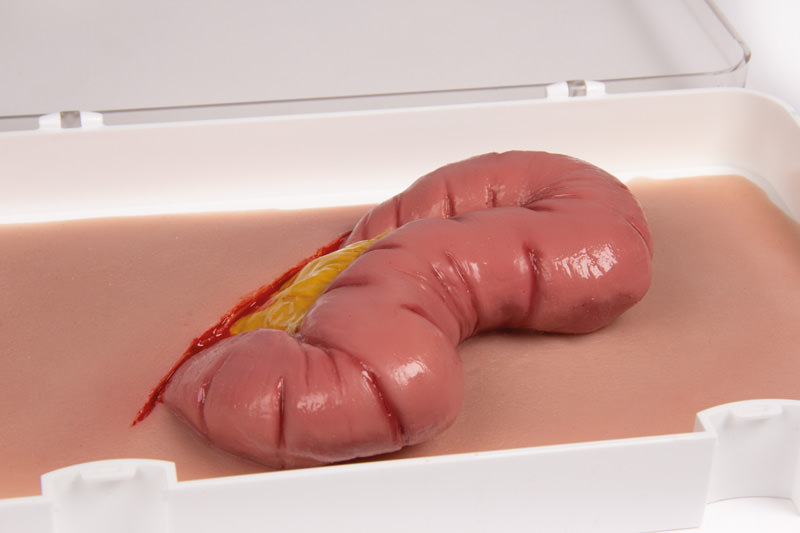 Wundmoulage Dickdarmaustritt